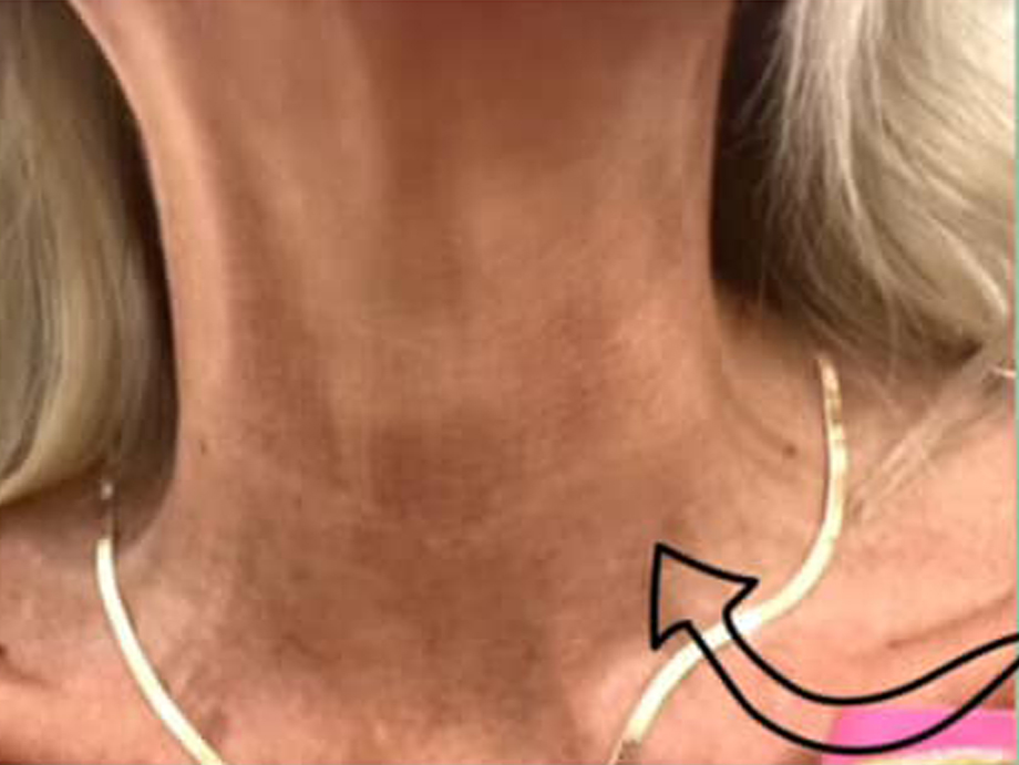 PM-After-Neck After Neck