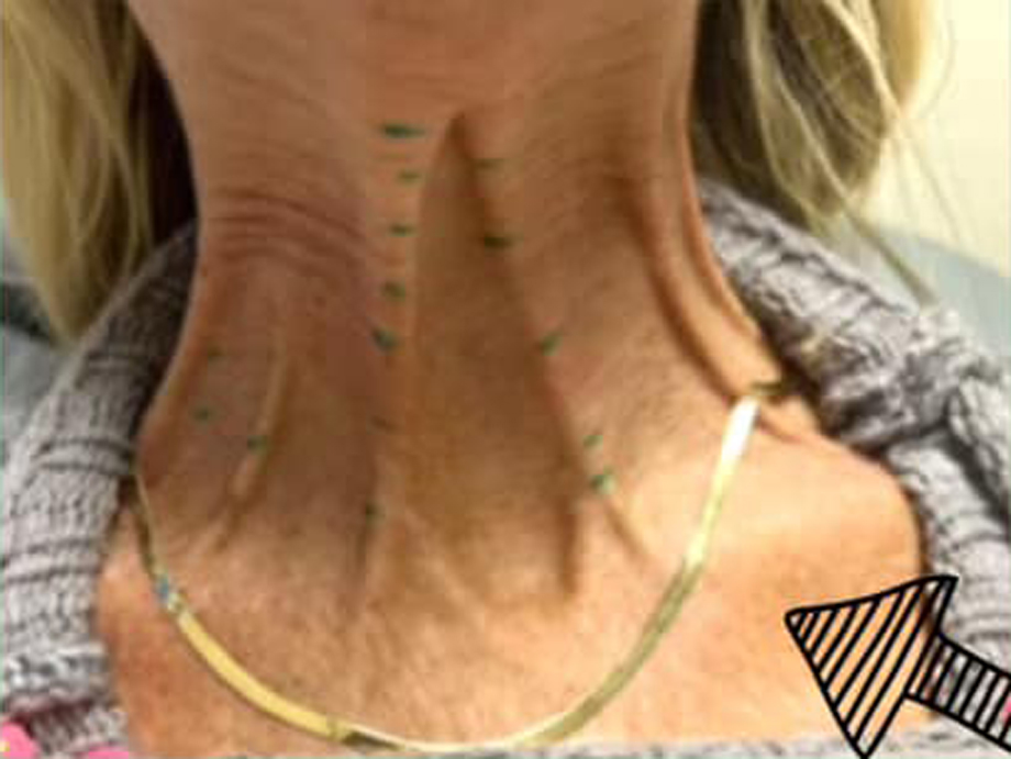 PM-Before-Neck Before Neck