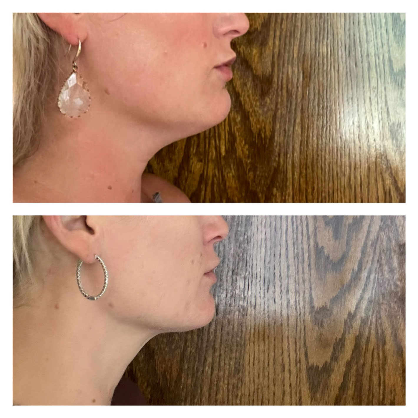 Premier-Kybella Before - After