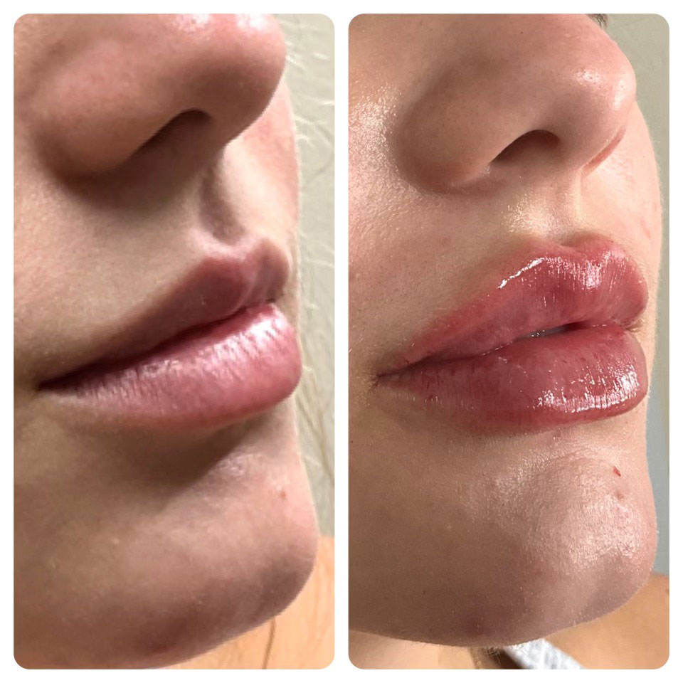 Premier-Lip-filler-(1) Lip filler