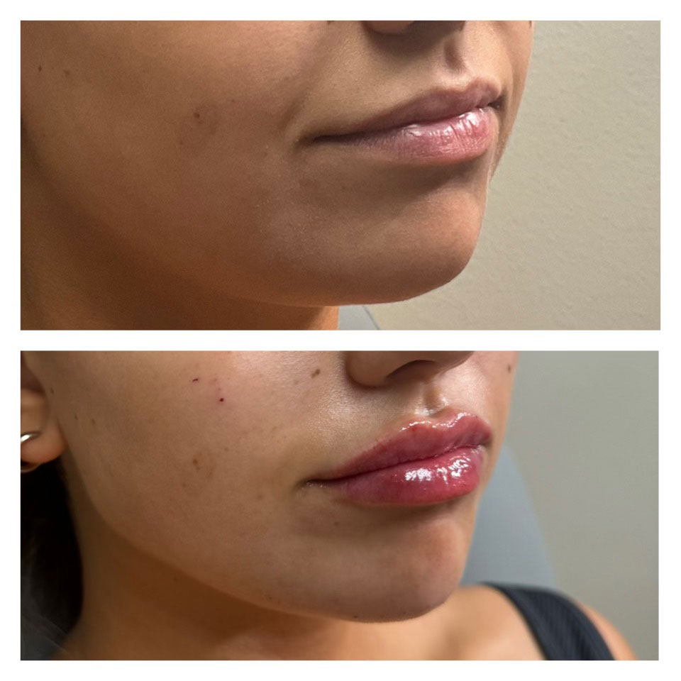 Premier-Lip-filler-(2) Lip filler