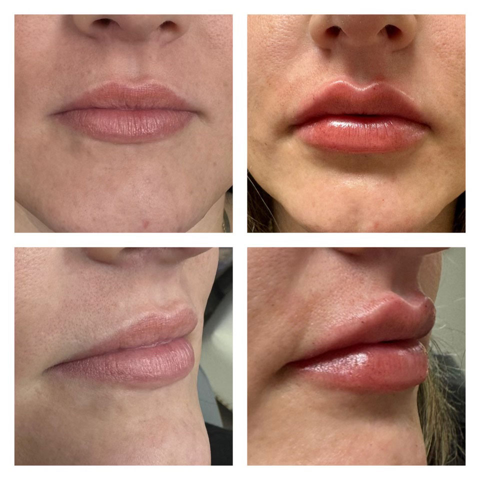 Premier-Lip-filler-(3) Lip filler