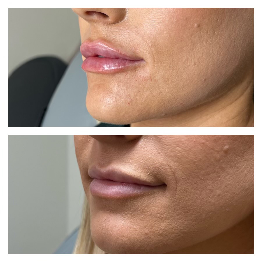 Premier-Lip-filler-(4) Lip filler