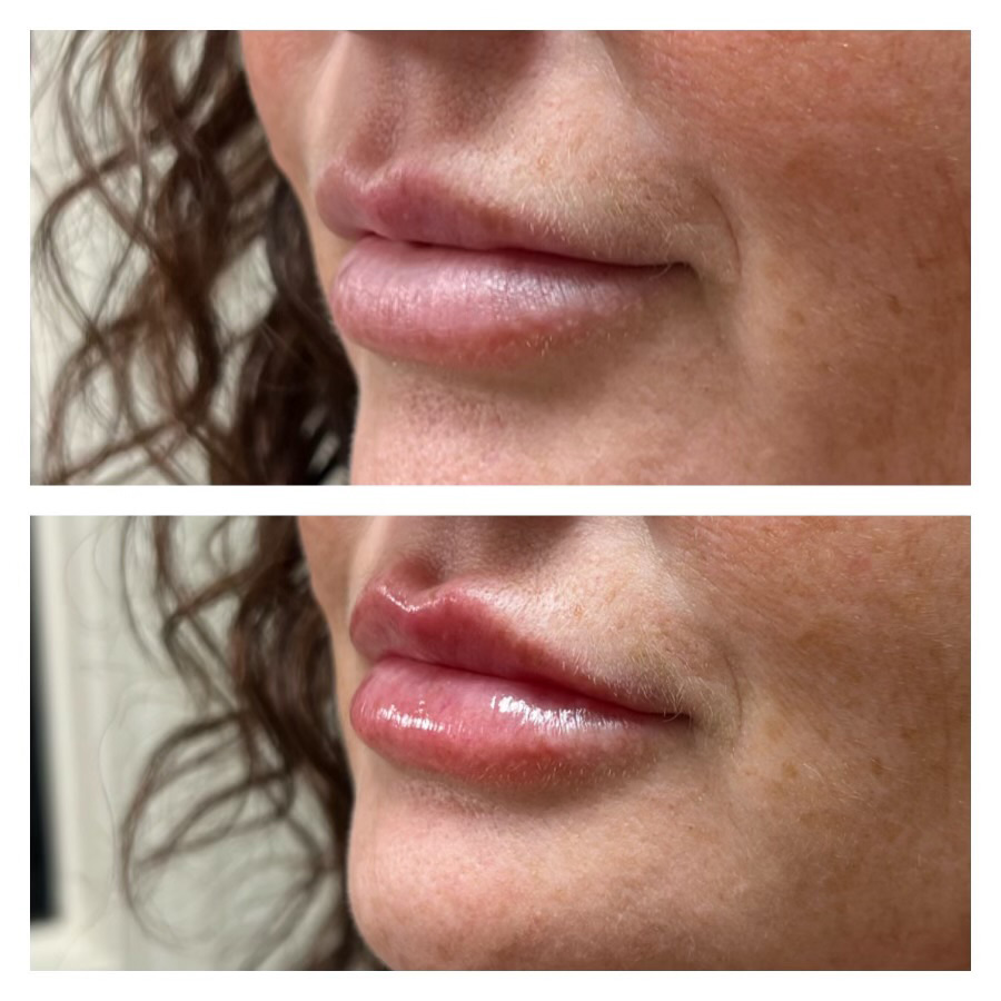 Premier-Lip-filler-(5) Lip filler