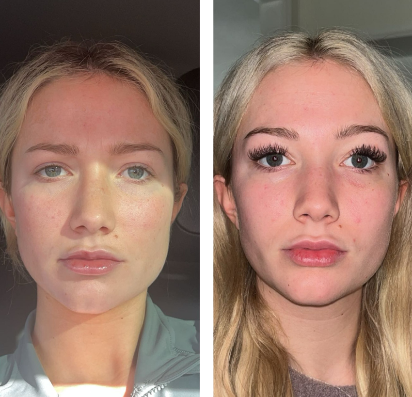 Premier-Masseter-injections injections