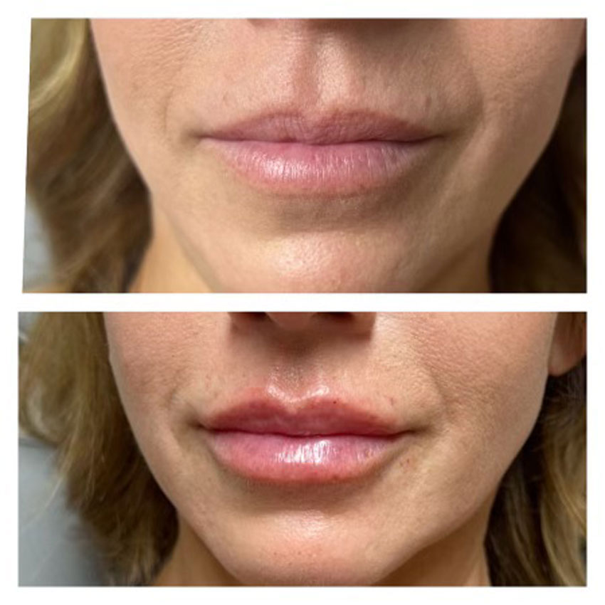 Premier-Medspa-Lip-filler Lip filler