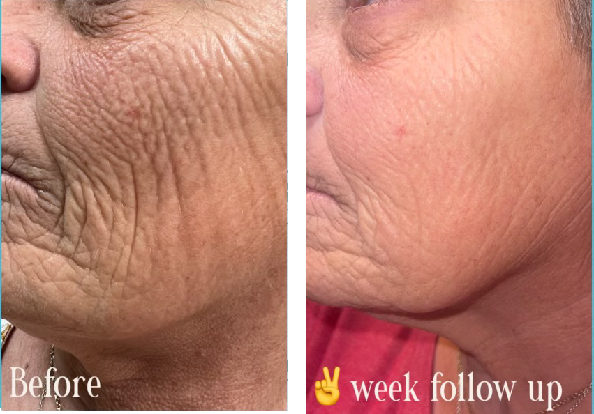 Premier-Skinvive Before - AfterSkinvive